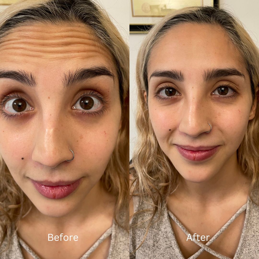 Before and After Image: Botox - front