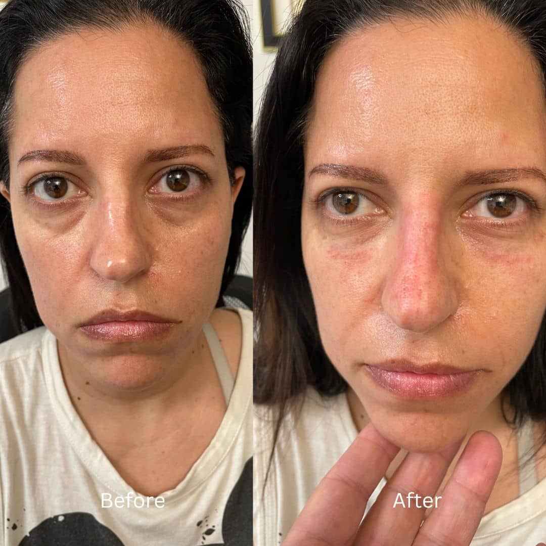 Before and After Image: Botox - front