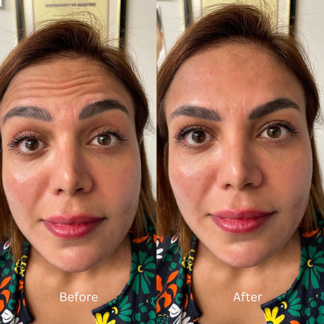 Before and After Image: Botox - front