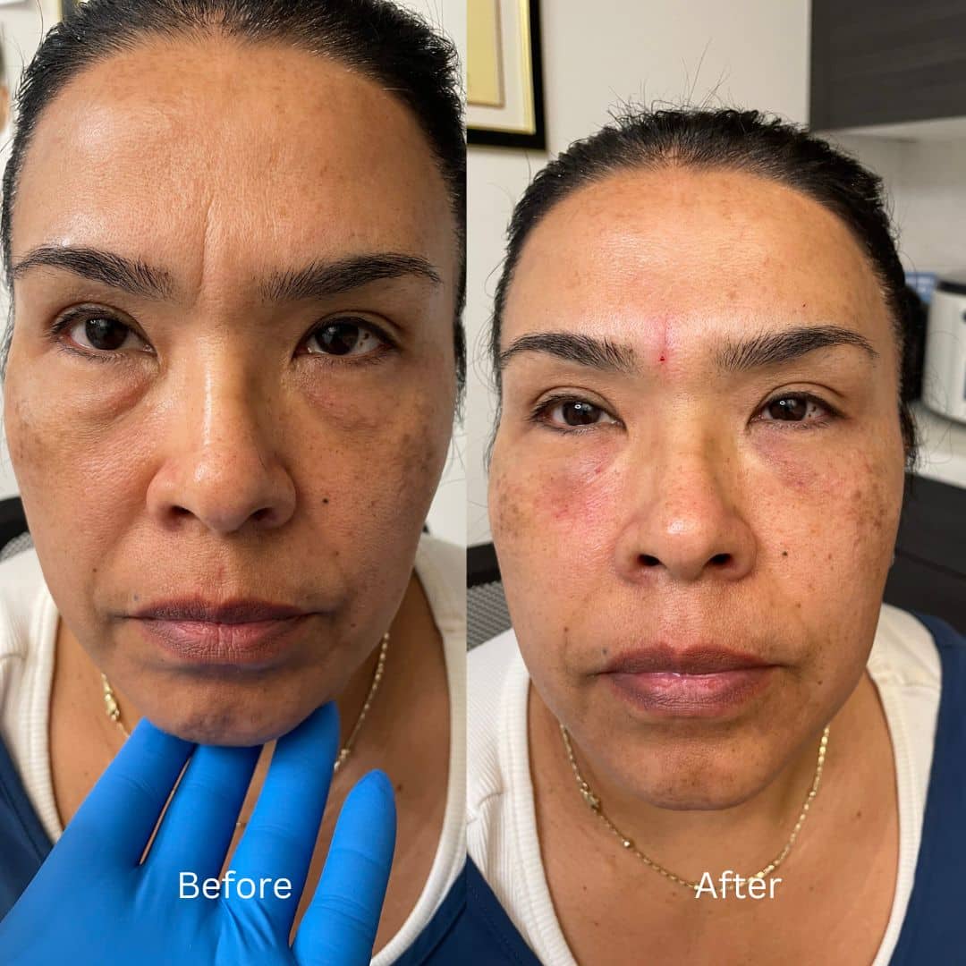 Before and After Image: Botox - front