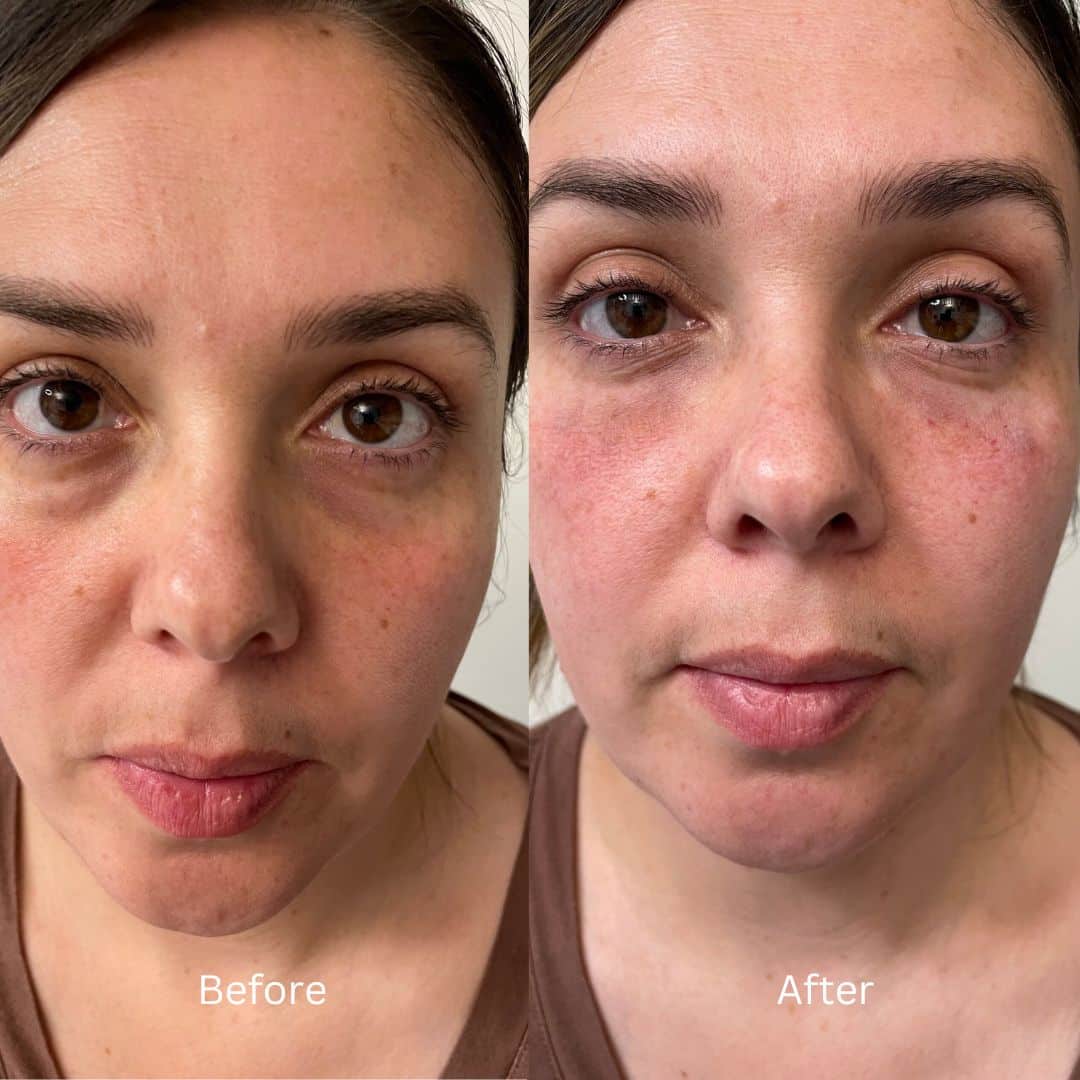 Before and After Image: Botox - front