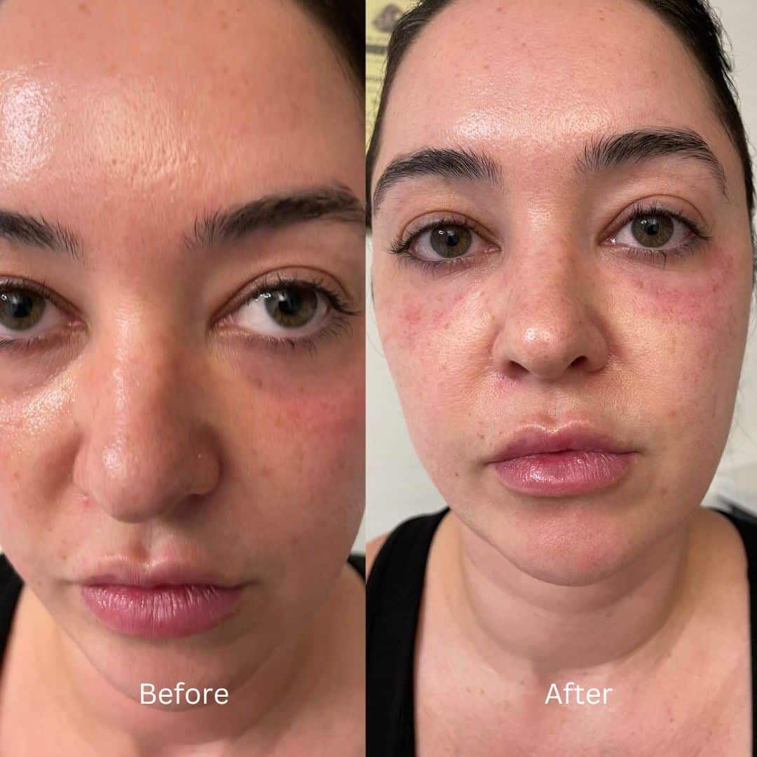 Before and After Image: Botox - front