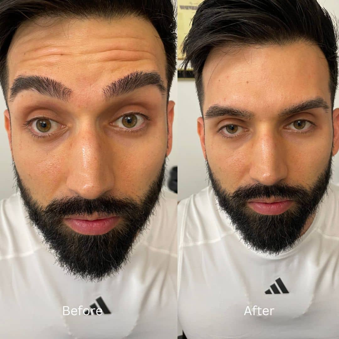 Before and After Image: Botox - front