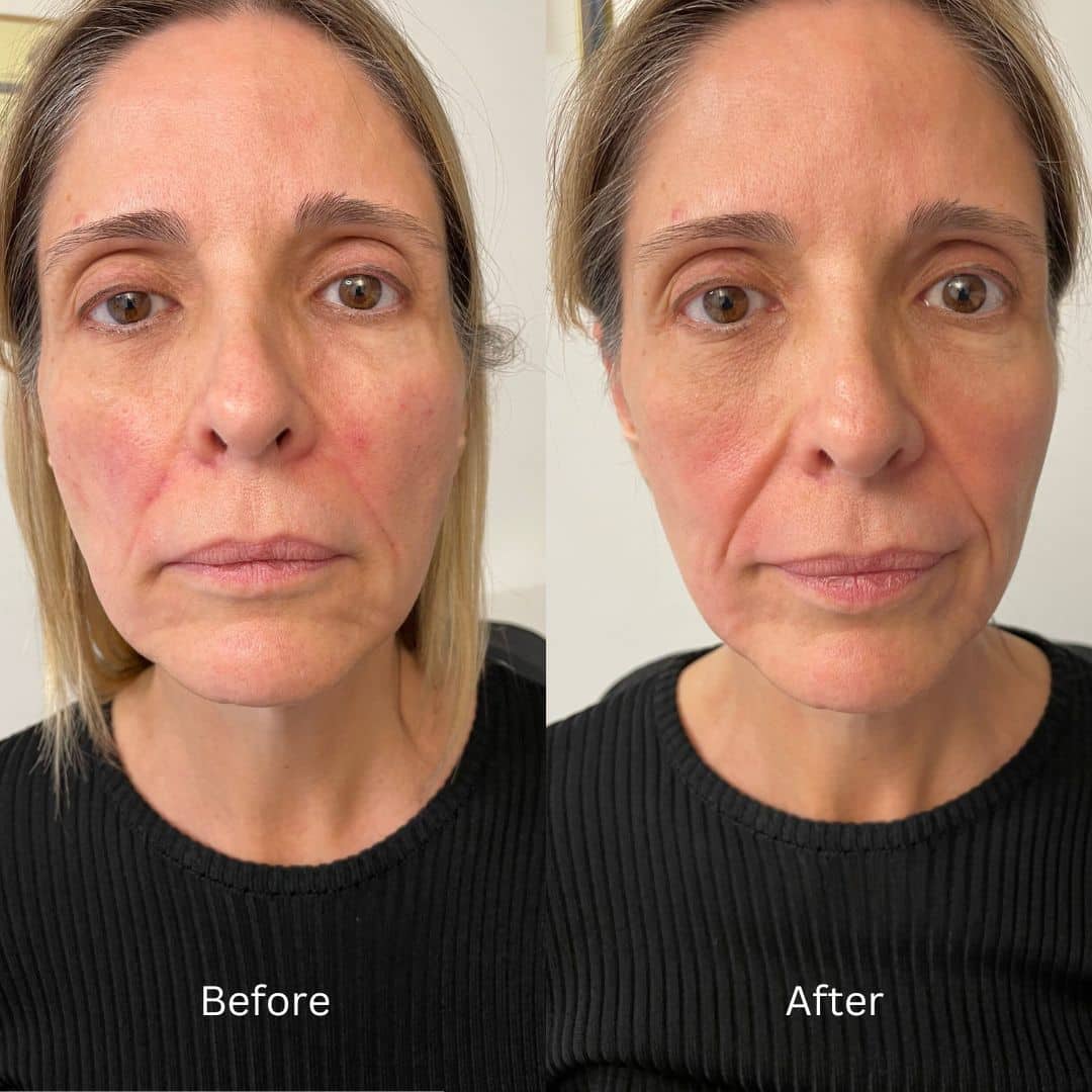 Before and After Image: Botox - front