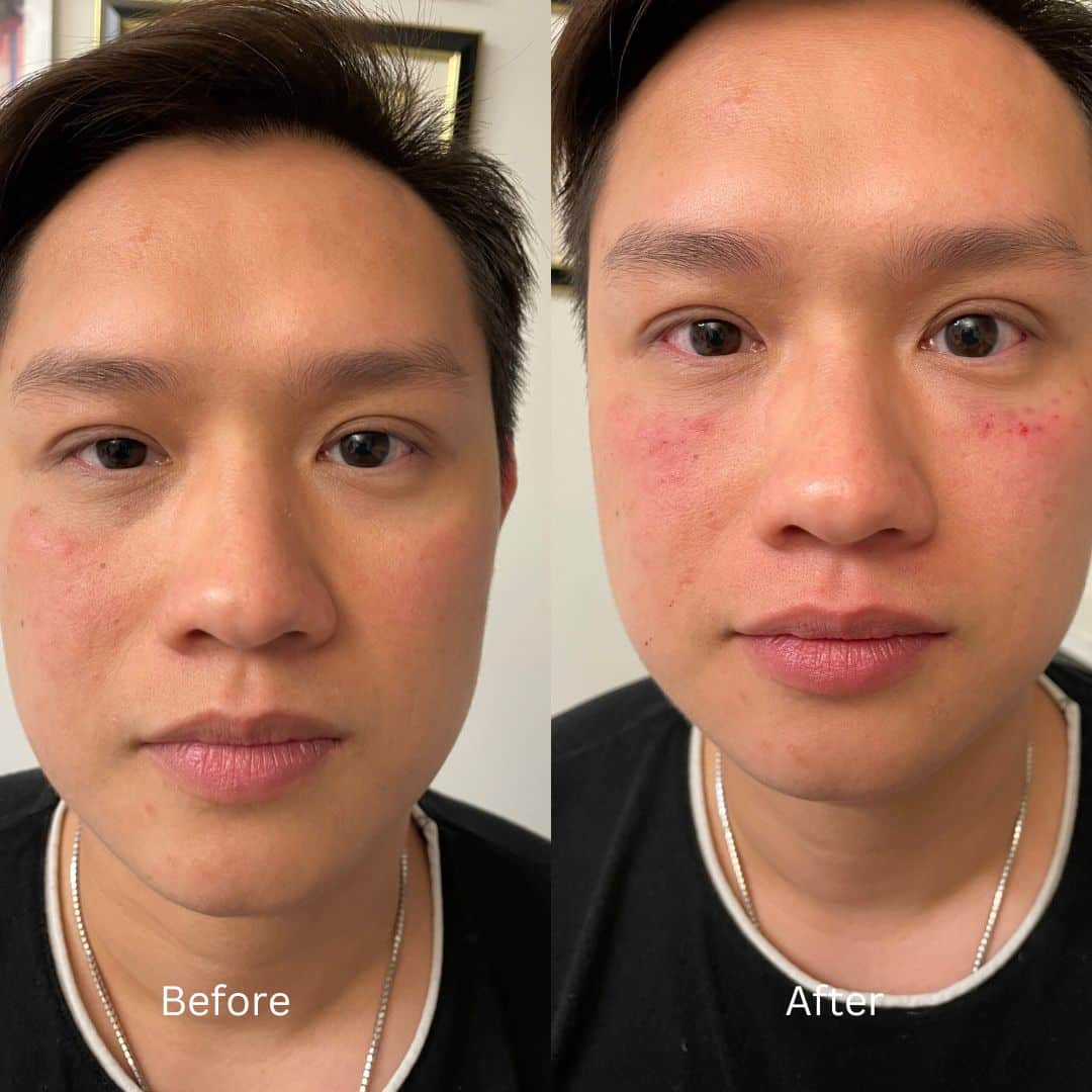 Before and After Image: Botox - front