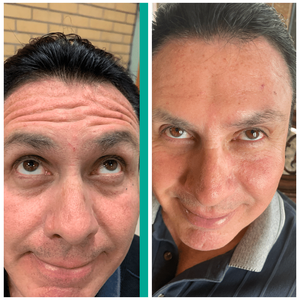 Before and After Image: Botox - front