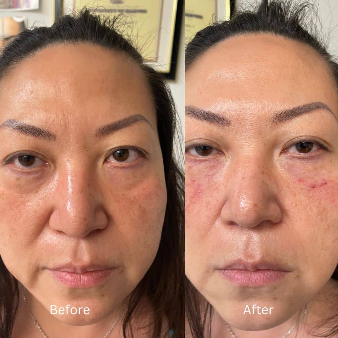 Before and After Image: Botox - front