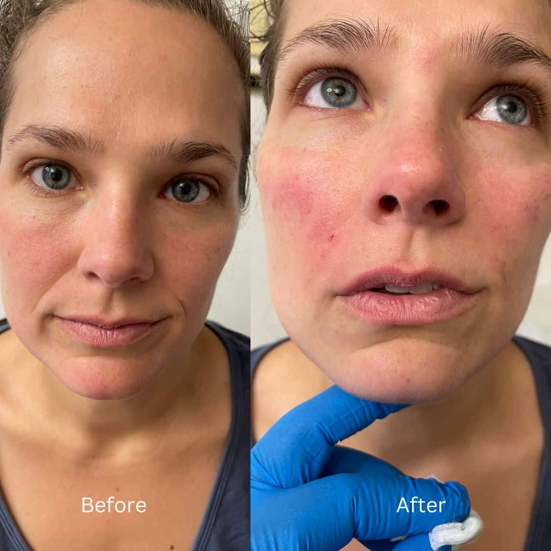 Before and After Image: Botox - front