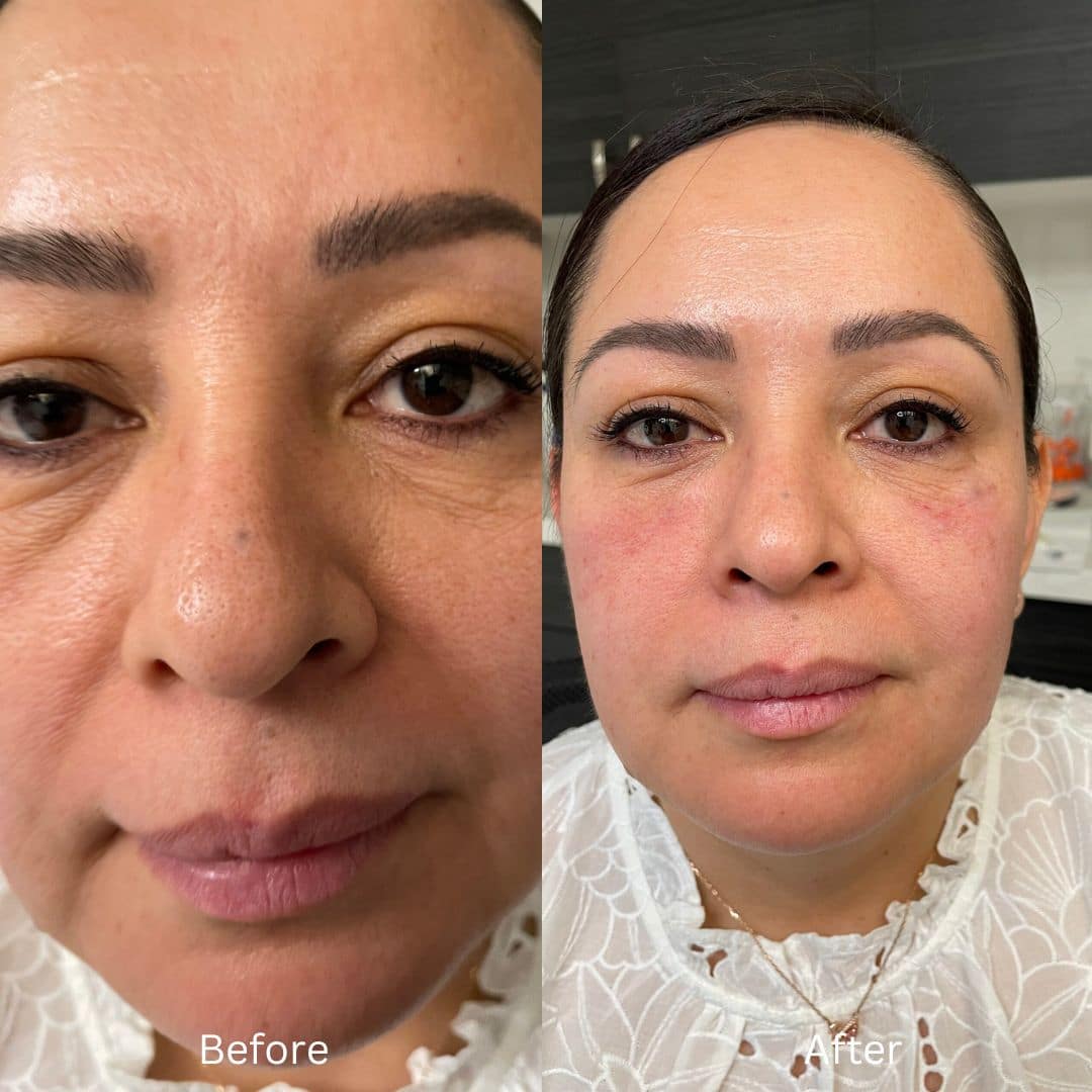 Before and After Image: Botox - front