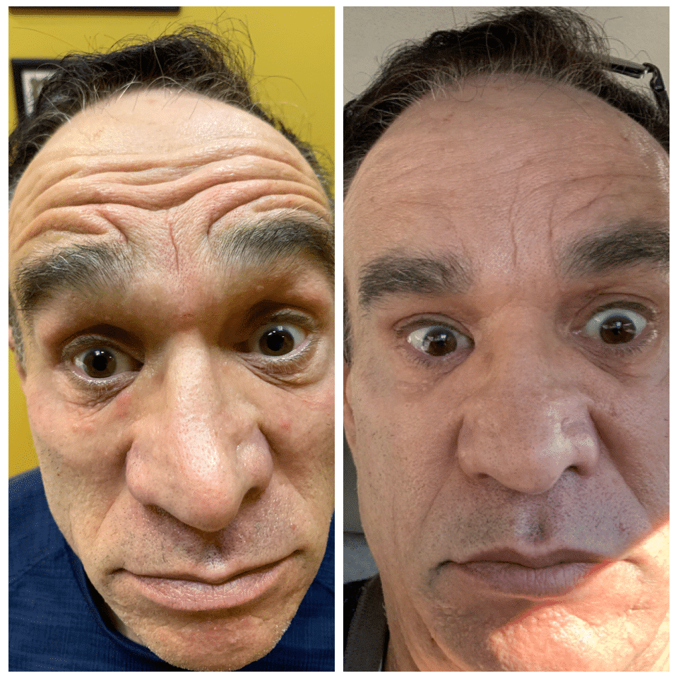 Before and After Image: Botox - front
