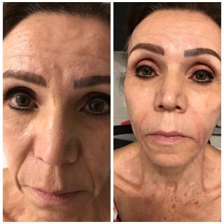 Before and After Image: Botox - front