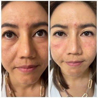 Before and After Image: Botox - front