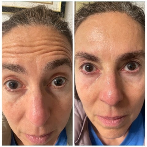 Before and After Image: Botox - front
