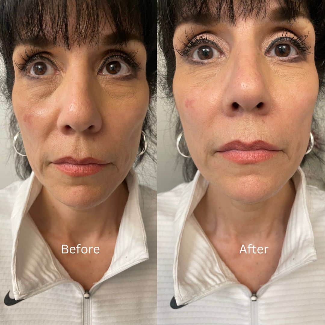Before and After Image: Botox - front