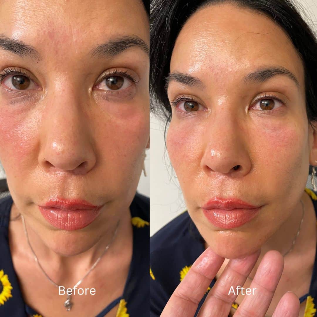 Before and After Image: Botox - front