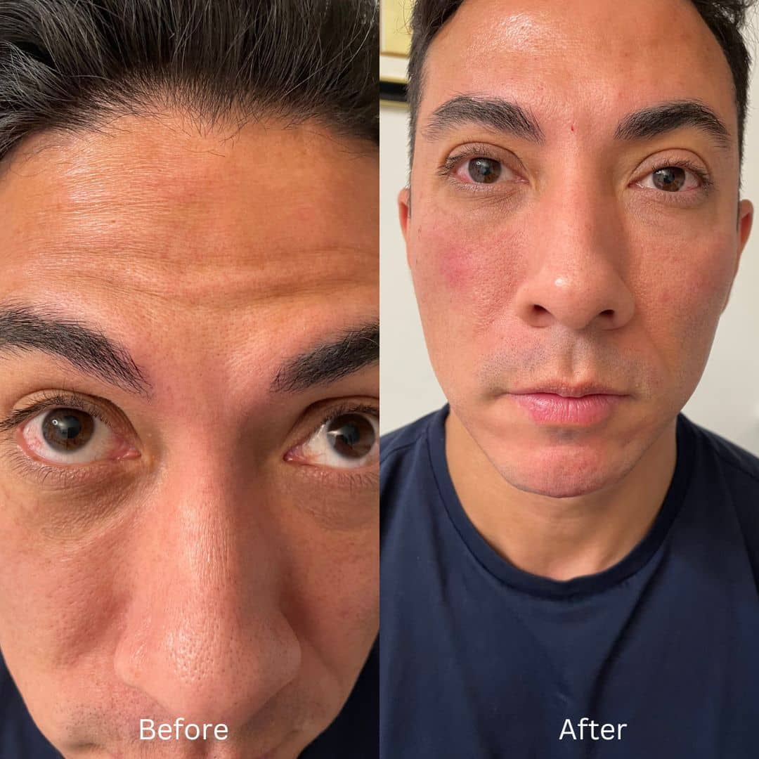 Before and After Image: Botox - front