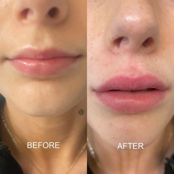 Before and After Image: Lip Filler - front