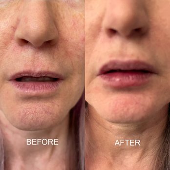 Before and After Image: Lip Filler - front