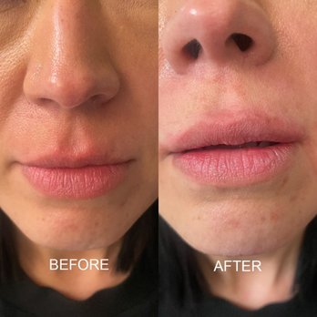 Before and After Image: Lip Filler - front