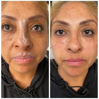 Before and After Image: Lip Filler - front