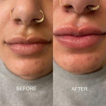 Before and After Image: Lip Filler - front