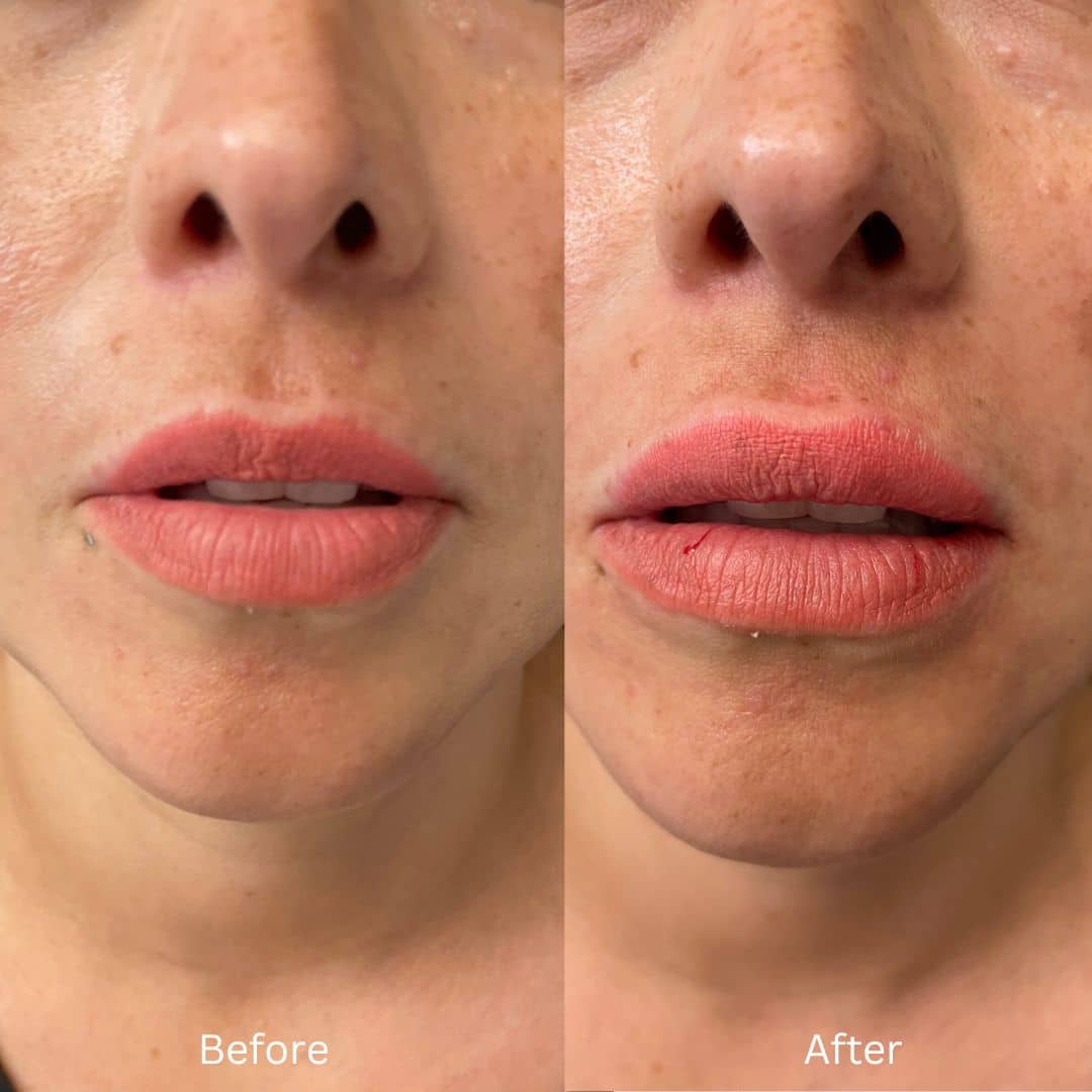 Before and After Image: Lip Filler - front