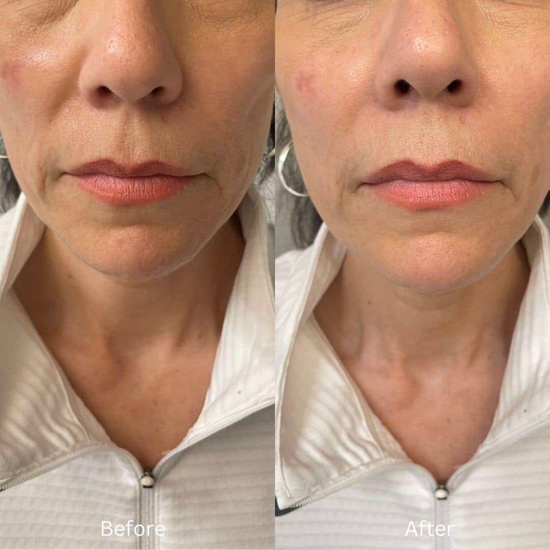 Before and After Image: Lip Filler - front