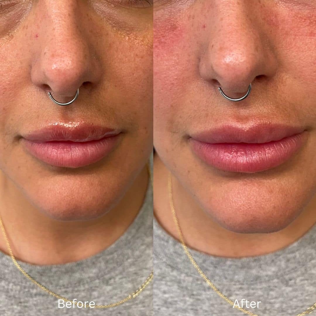 Before and After Image: Lip Filler - front