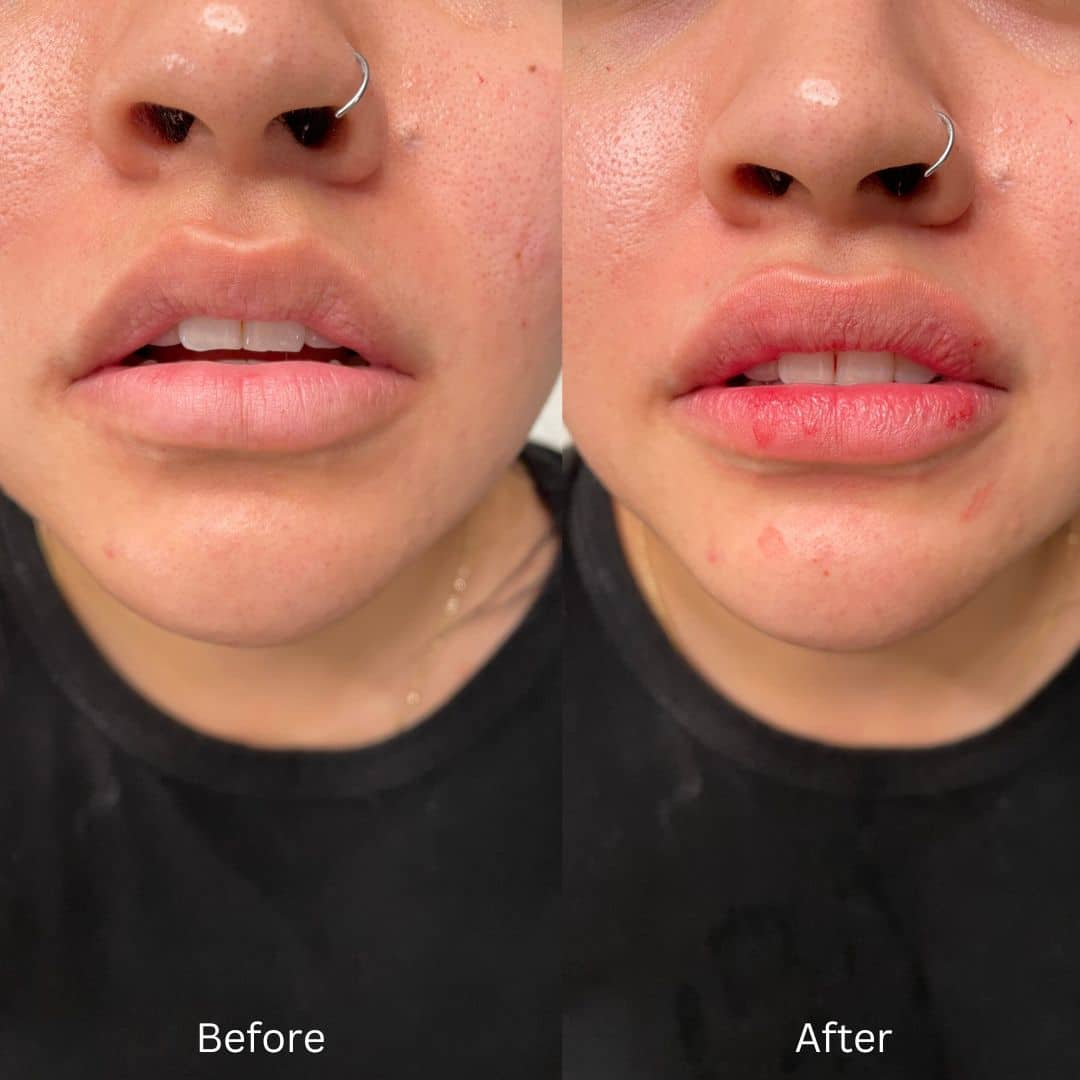 Before and After Image: Lip Filler - front