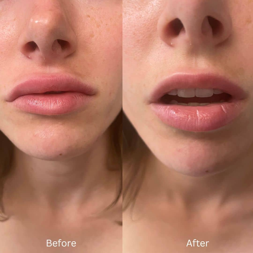 Before and After Image: Lip Filler - front