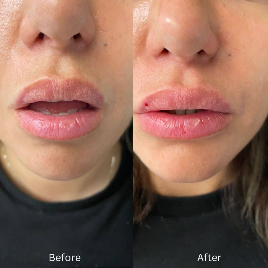 Before and After Image: Lip Filler - front