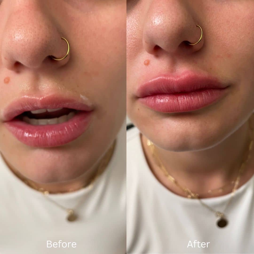 Before and After Image: Lip Filler - front