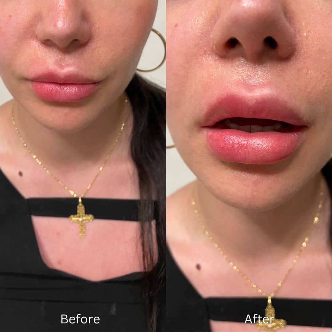 Before and After Image: Lip Filler - front