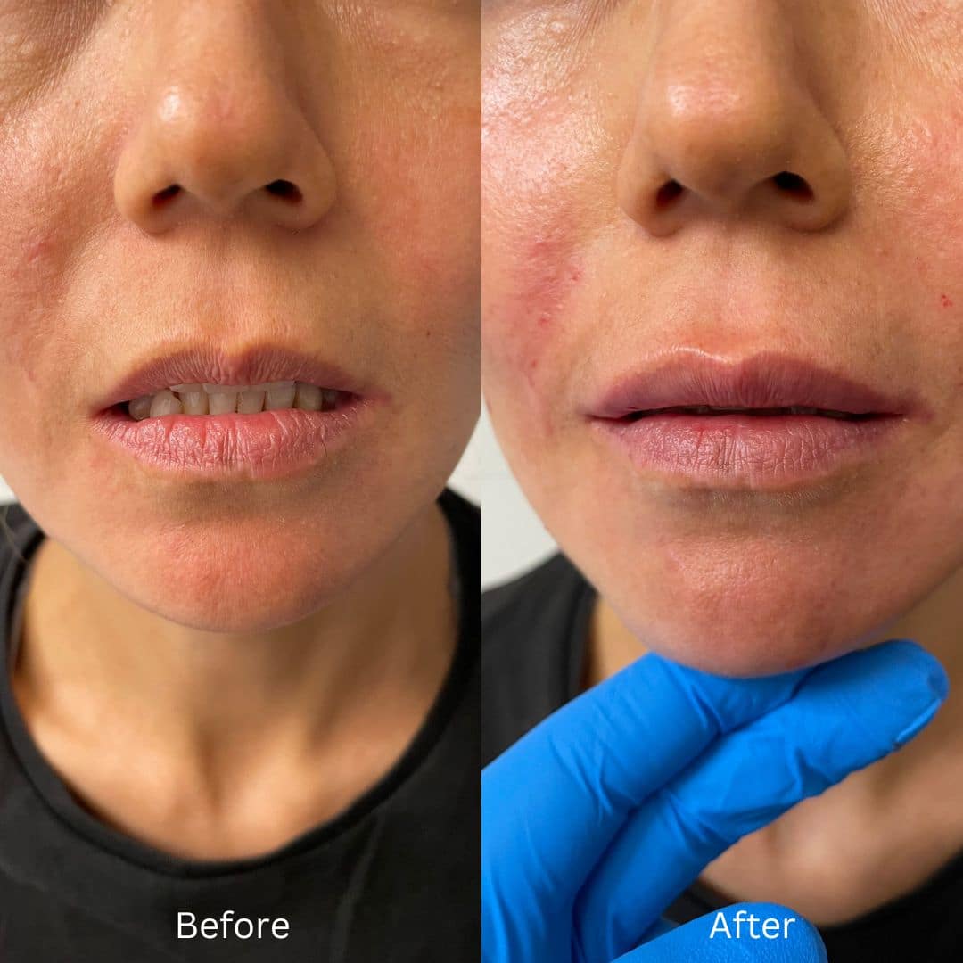 Before and After Image: Lip Filler - front