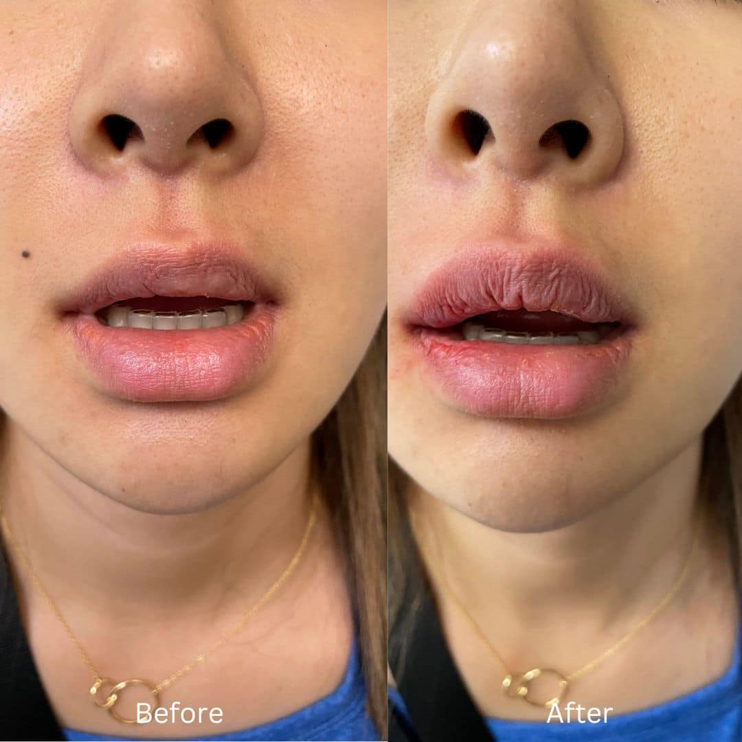 Before and After Image: Lip Filler - front