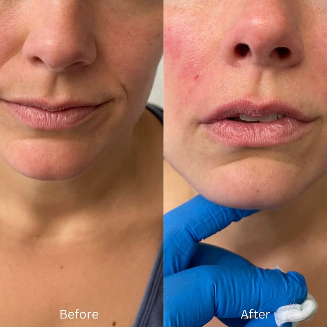 Before and After Image: Lip Filler - front