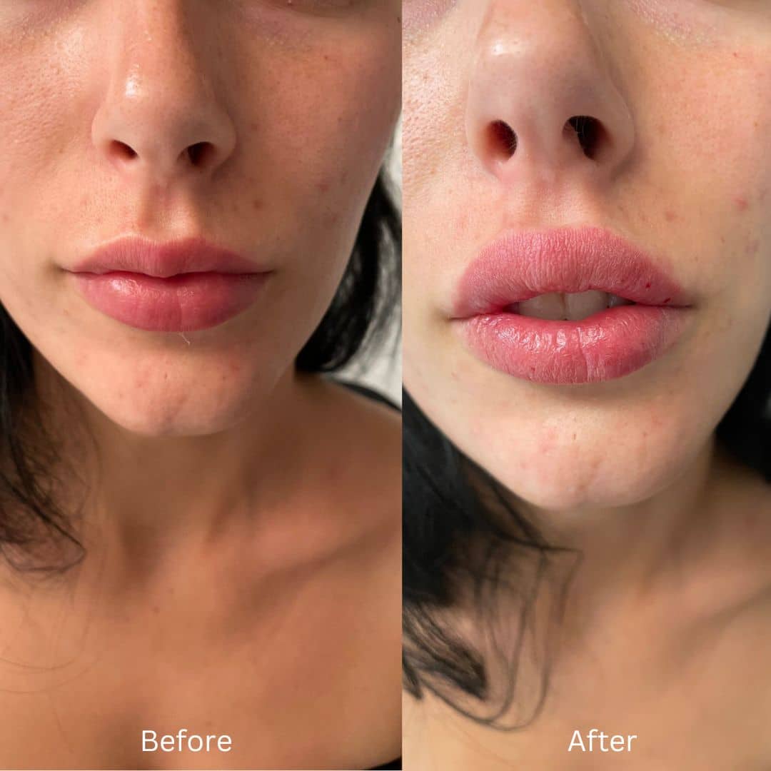 Before and After Image: Lip Filler - front