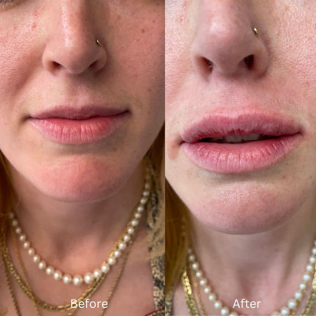 Before and After Image: Lip Filler - front