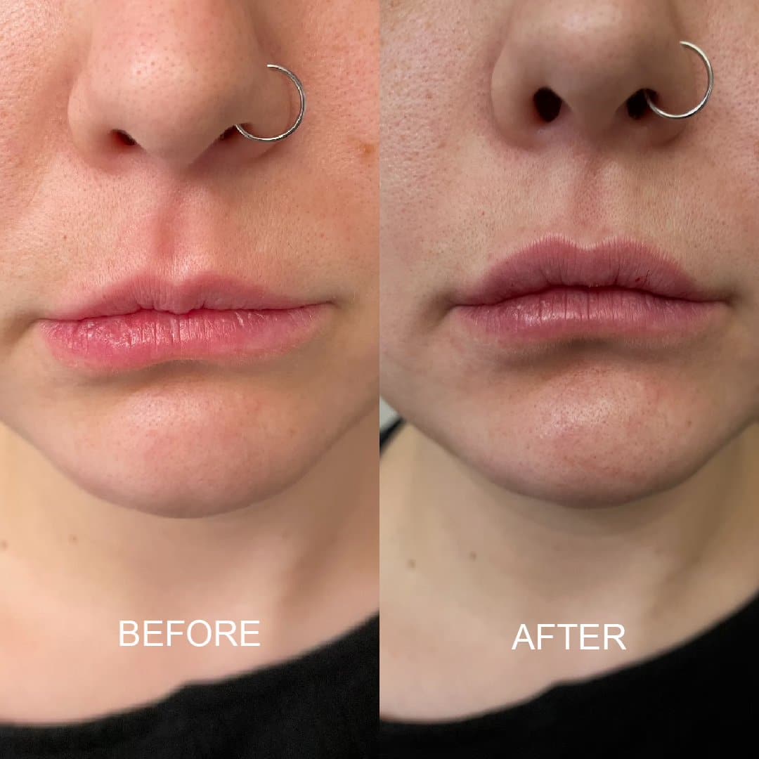 Before and After Image: Lip Filler - front
