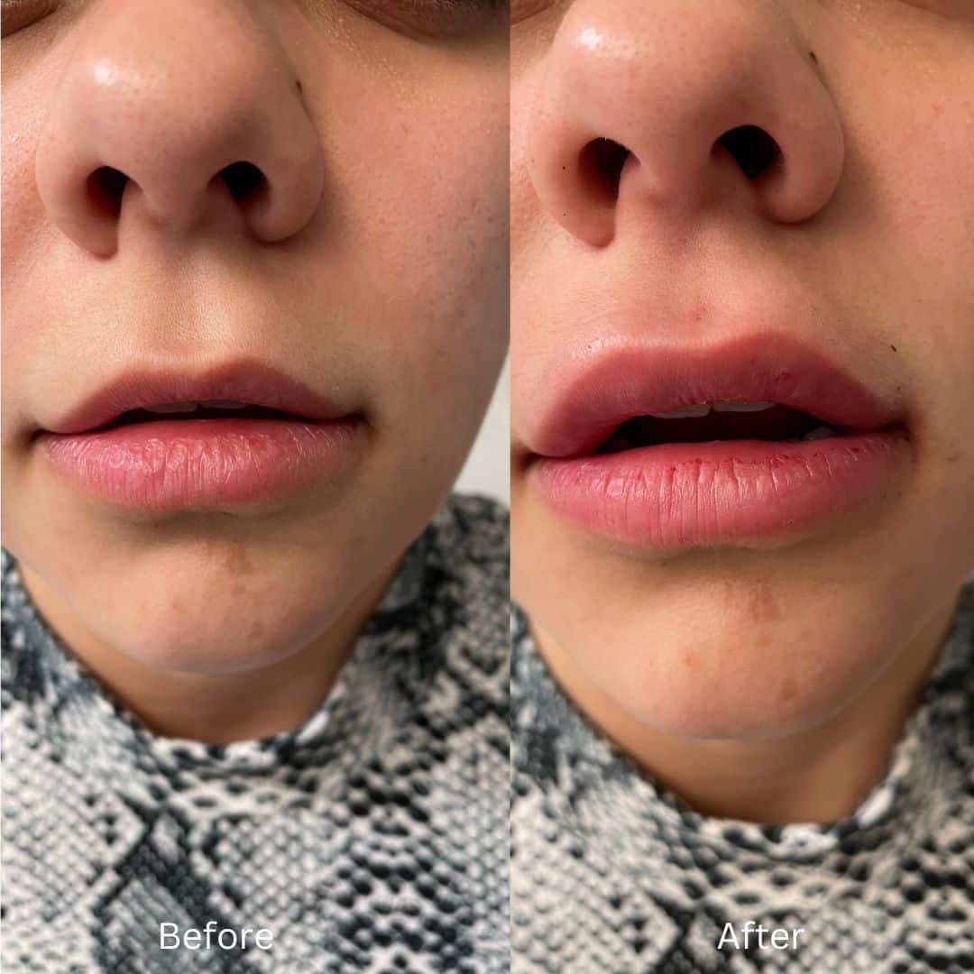 Before and After Image: Lip Filler - front