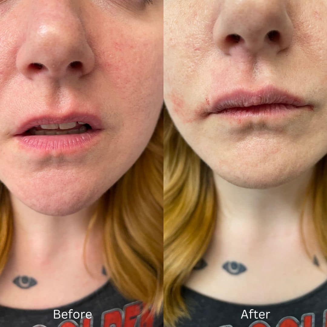 Before and After Image: Lip Filler - front
