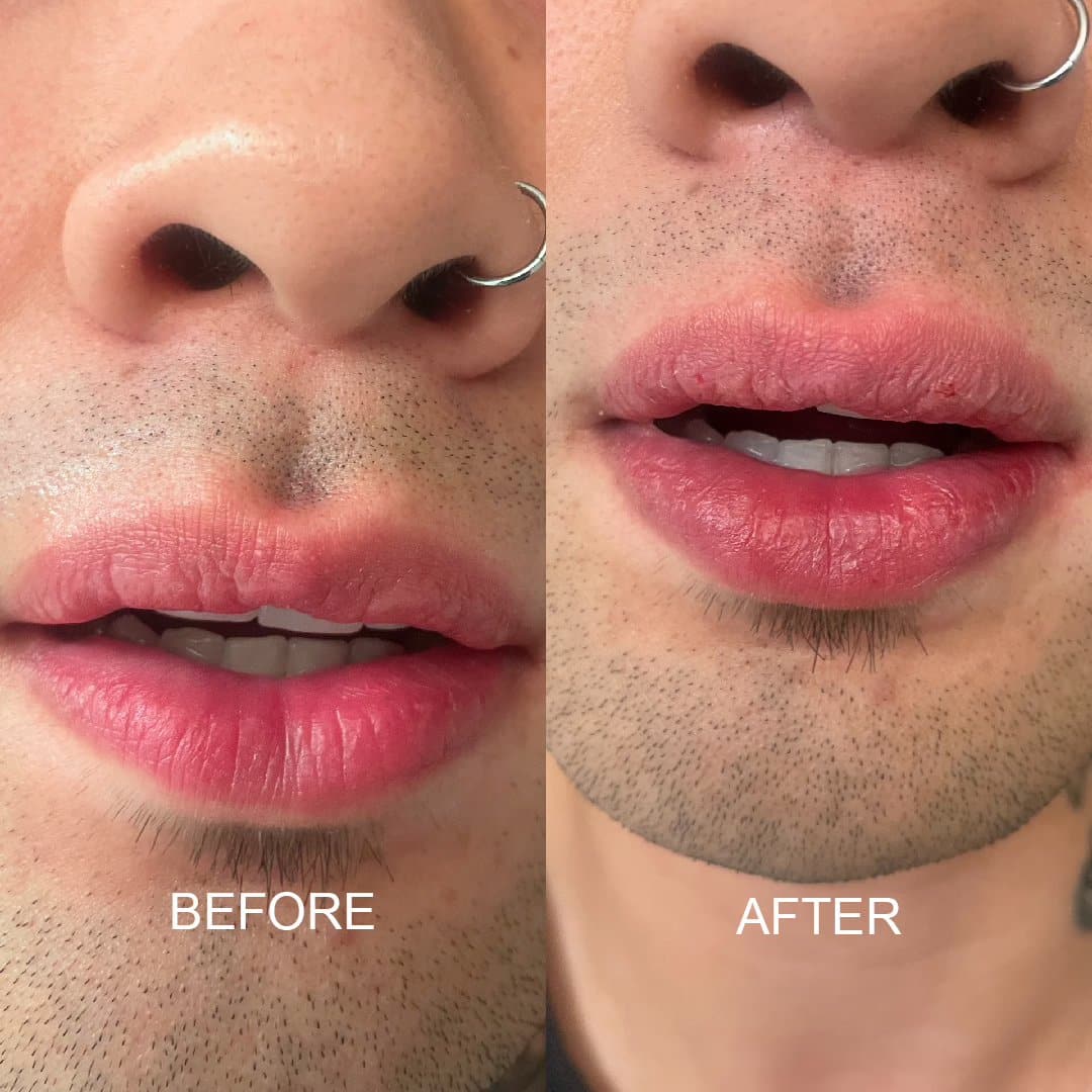 Before and After Image: Lip Filler - front