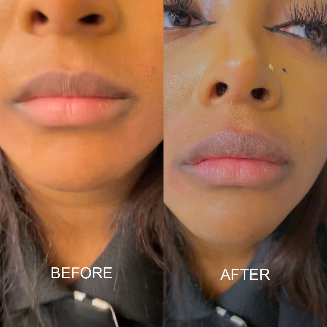 Before and After Image: Lip Filler - front