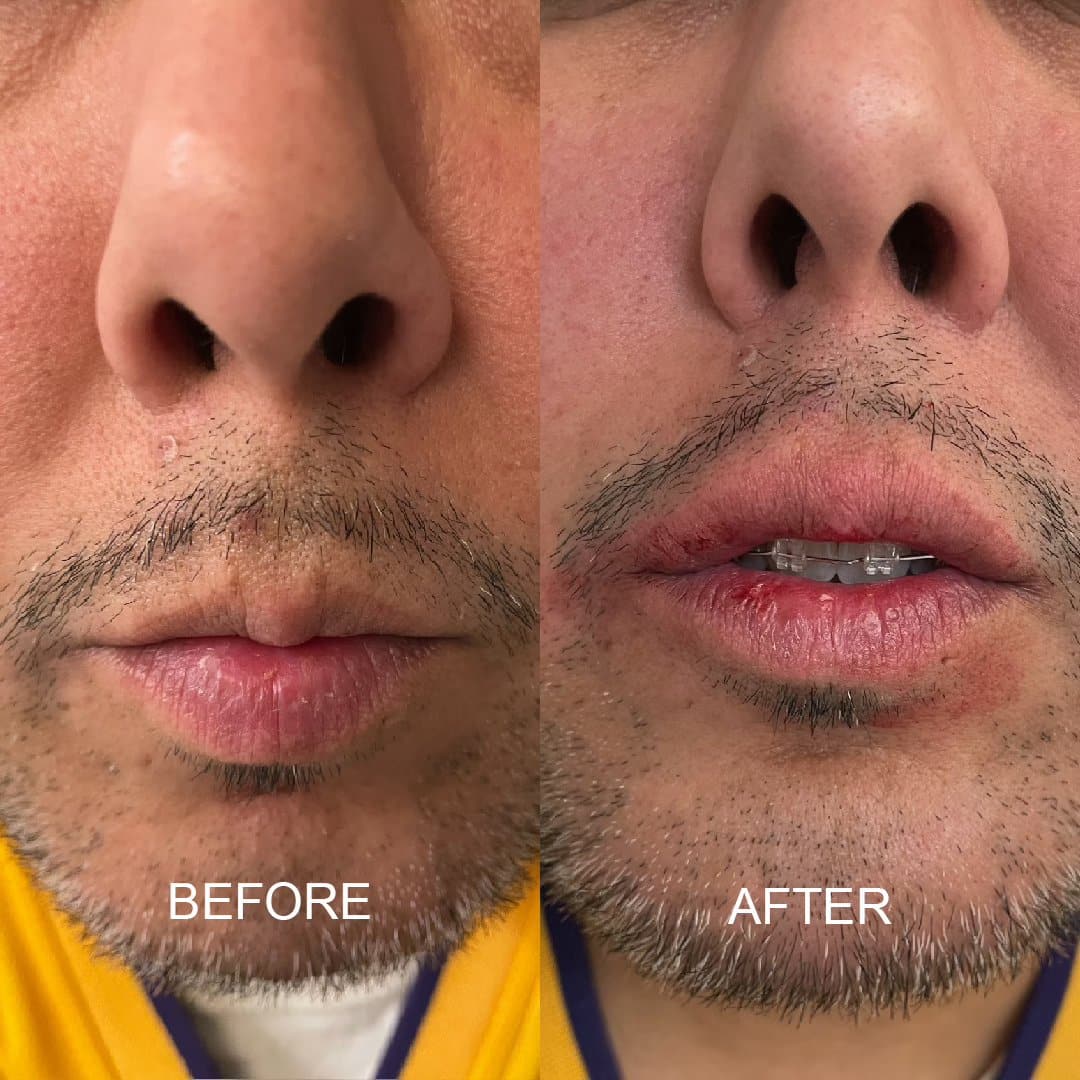 Before and After Image: Lip Filler - front