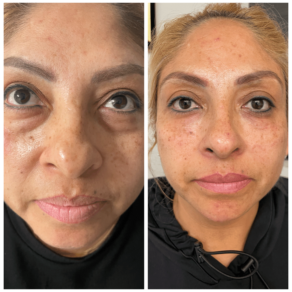 Before and After Image: Nasal Correction - front