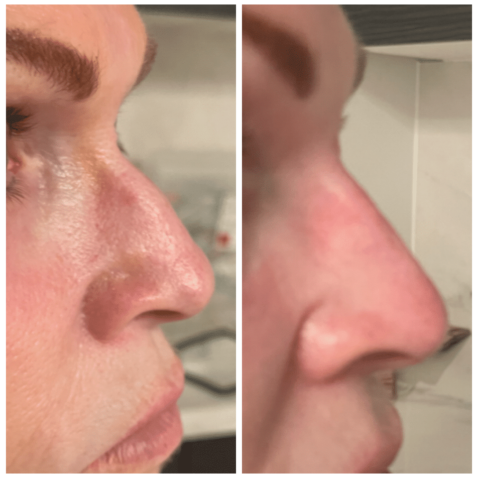 Before and After Image: Nasal Correction - right-side