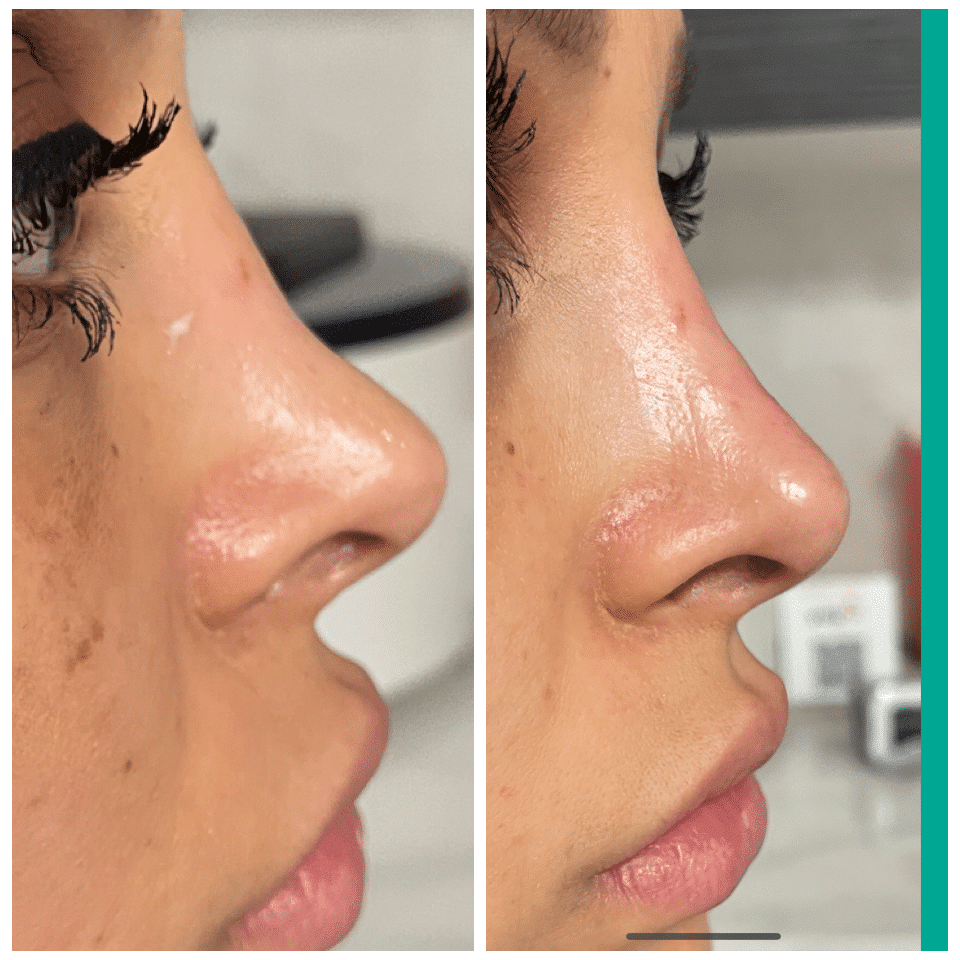 Before and After Image: Nasal Correction - right-side