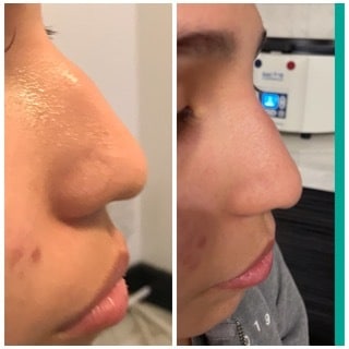 Before and After Image: Nasal Correction - right-side