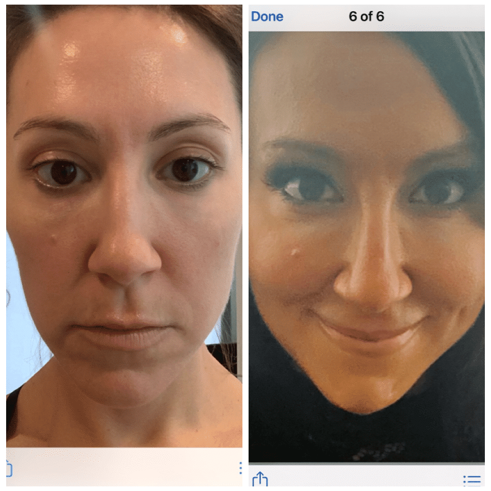 Before and After Image: Nasal Correction - front