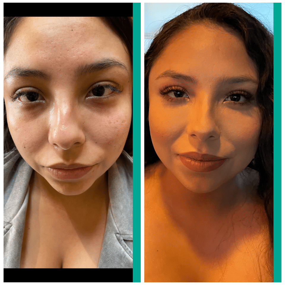 Before and After Image: Nasal Correction - front
